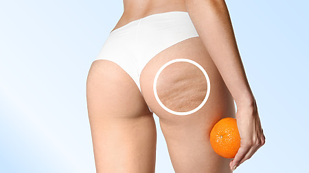 Celulitis