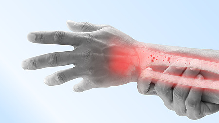Osteoporosis: una causa frecuente de fracturas