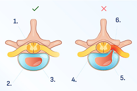 Hernia discal de vértebras lumbares
